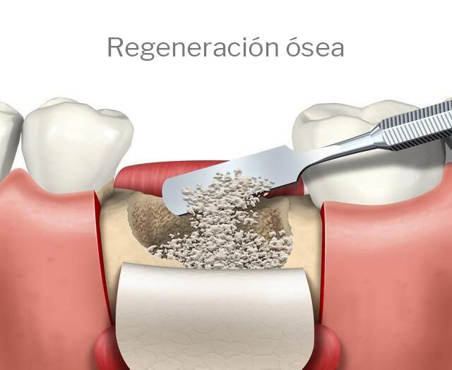 Regeneración ósea